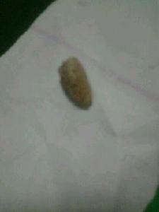 排出結石 排出結石