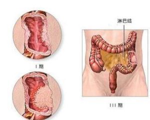 左半結腸癌 左半結腸癌