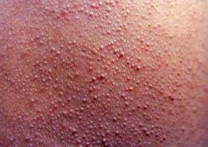 維生素C缺乏病症狀