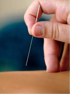 針灸減肥 針灸減肥