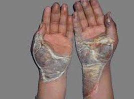 燒傷創面蒼白或焦黃炭化 燒傷創面蒼白或焦黃炭化