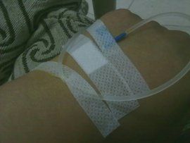 靜脈輸液 靜脈輸液