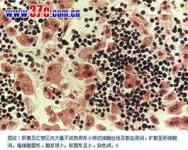 急性髓性白血病 急性髓性白血病