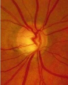 慢性閉角青光眼 慢性閉角青光眼