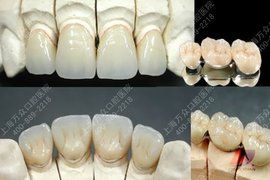 純鈦烤瓷牙 純鈦烤瓷牙