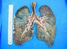 碳黑塵肺