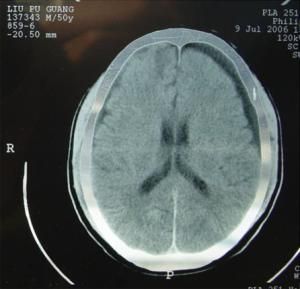 外傷性硬膜下積液 外傷性硬膜下積液