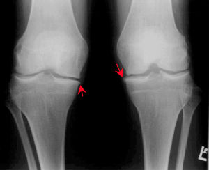關節退行性變 關節退行性變