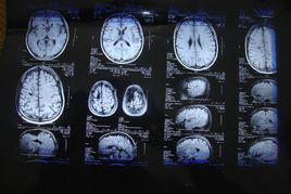 腦軟化灶 腦軟化灶