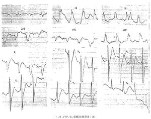 新生兒心律失常
