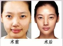 人中加深術 人中加深術