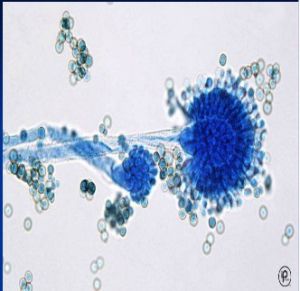 肺真菌病 肺真菌病