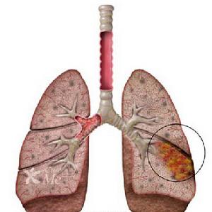 小兒支原體肺炎 小兒支原體肺炎