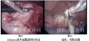 先天性巨結腸症