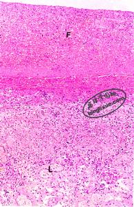 圖6 胸膜纖維素性炎F：滲出纖維素 L：胸膜組織