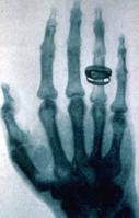 倫琴拍攝的第一張X射線片