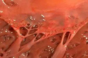 亞急性感染性心內膜炎