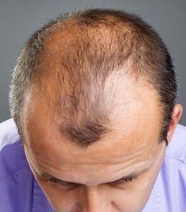 男性型脫髮 男性型脫髮