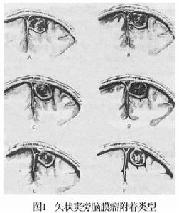 矢狀竇旁腦膜瘤