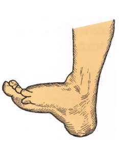 脛神經損傷 脛神經損傷