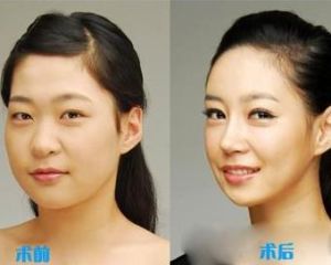 臉部吸脂 臉部吸脂