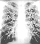 普通問質性肺炎