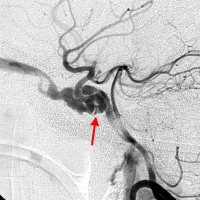 外傷性頸內動脈海綿竇瘺