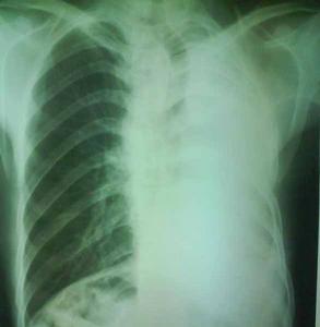 上腔靜脈受壓綜合徵