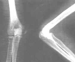 肱骨內上髁骨折 肱骨內上髁骨折