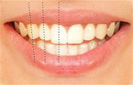 牙體長軸 牙體長軸
