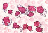 惡性組織細胞病 惡性組織細胞病