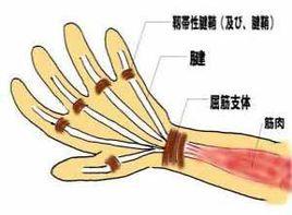 手指不能屈伸 手指不能屈伸