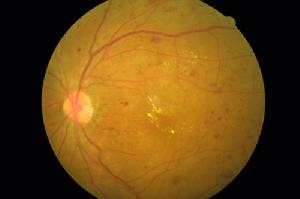 白血病視網膜病變