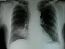 Kartagener綜合徵 Kartagener綜合徵