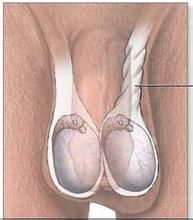 小兒睪丸鞘膜積液 小兒睪丸鞘膜積液