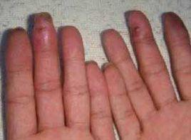 手指發紺或壞死