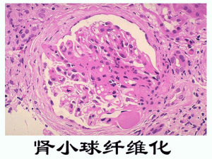 急性腎小球腎炎