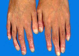 皮膚彈性過度綜合徵 皮膚彈性過度綜合徵