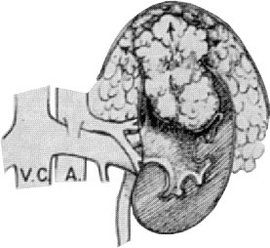 腎臟腫瘤 腎臟腫瘤