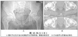 加壓螺絲釘內固定術 加壓螺絲釘內固定術
