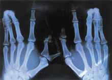 抗維生素D佝僂病