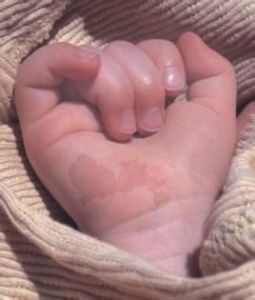 咖啡牛奶斑 咖啡牛奶斑