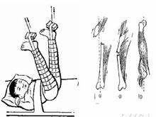 石膏綜合徵 石膏綜合徵