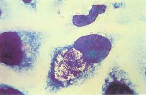 衣原體病 衣原體病