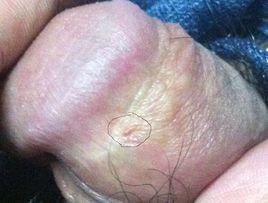 潛伏期尖銳濕疣