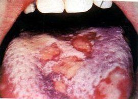 皰疹性口炎 皰疹性口炎