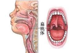慢性舌扁桃體炎
