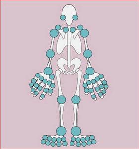 幼年型類風濕性關節炎