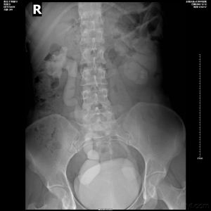 先天性巨輸尿管 先天性巨輸尿管