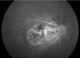 先天性黃斑缺損 先天性黃斑缺損